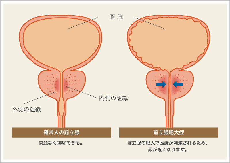 前立腺肥大