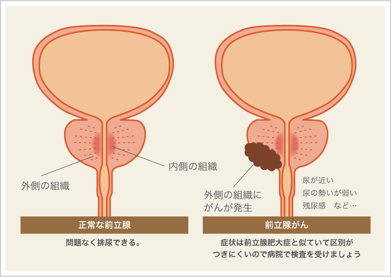 前立腺がん