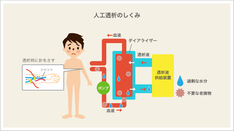 人工透析のしくみ